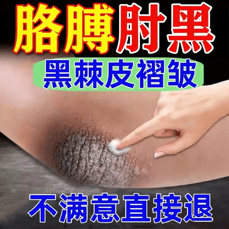 葵花胳膊肘黑色素沉淀去除手肘快速去黑淡化胳膊肘黑色素去黑去皮角质 【三盒】一抹转白 京东折扣/优惠券