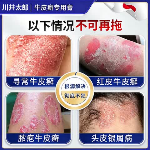 卫莱恩铜片白癜风日本进口膏白斑花斑汗斑快速消退外用遮盖神器官方正品 1盒装【体验发正装】 【官方直售 京质保障】