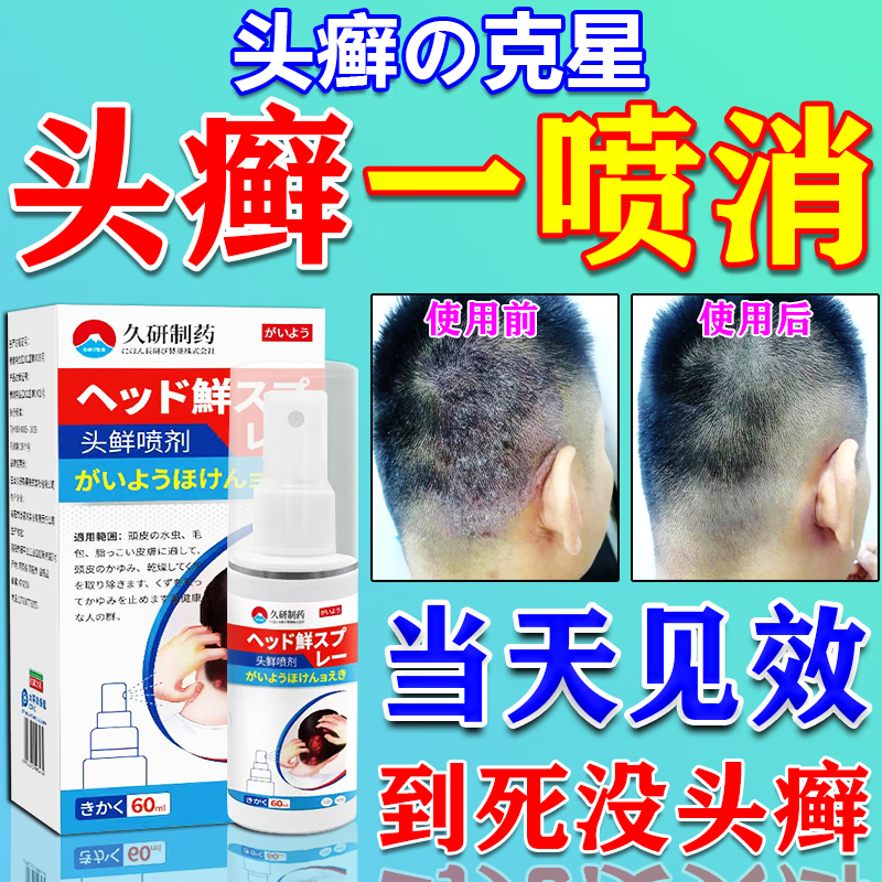 久研制药头癣头皮癣专用效喷剂真菌感染头皮屑瘙痒牛皮癣银屑病100%效去跟 药剂【100%根断】一瓶