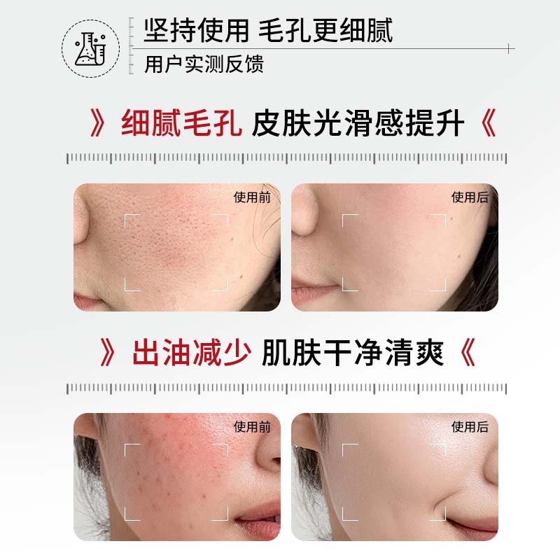 杏仁酸精华液祛痘黑头收毛孔粉刺闭口 三瓶
