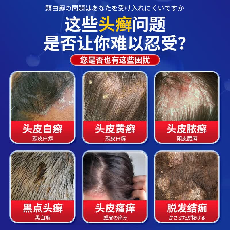 久研制药头癣头皮癣专用效喷剂真菌感染头皮屑瘙痒牛皮癣银屑病100%效去跟 药剂【100%根断】一瓶