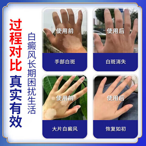 卫莱恩铜片白癜风日本进口膏白斑花斑汗斑快速消退外用遮盖神器官方正品 1盒装【体验发正装】 【官方直售 京质保障】