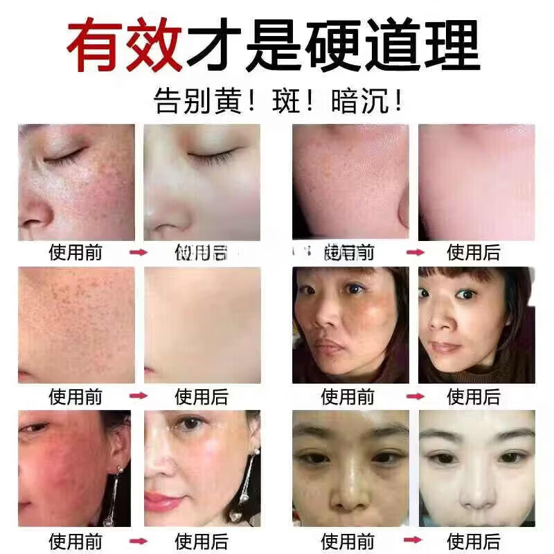 思丽安乳膏壬二酸20%祛痘凝胶去粉刺闭口淡化痘印玫瑰痤疮软霜膏 买3送2【5盒】巩固装