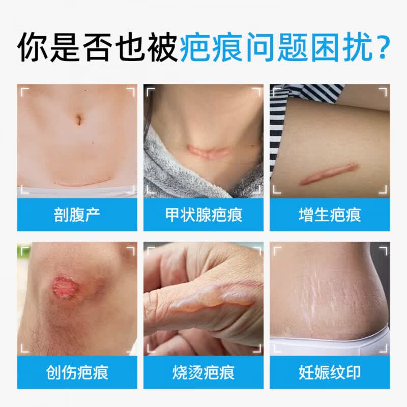 芭贝畅医用疤痕软膏硅酮凝胶祛疤膏去疤痕修复除疤烫伤手术剖腹产 三支买二赠一【抚平旧疤】 【官方旗舰 京质保障】