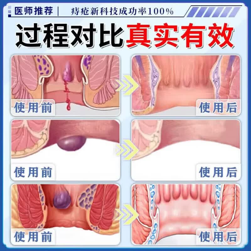 优朵花凝胶敷料有朵花忧多话内外混合痔肛裂瘙痒便血膏 1支【体验发正装】周期效果更佳 【官方直售 京质保障】