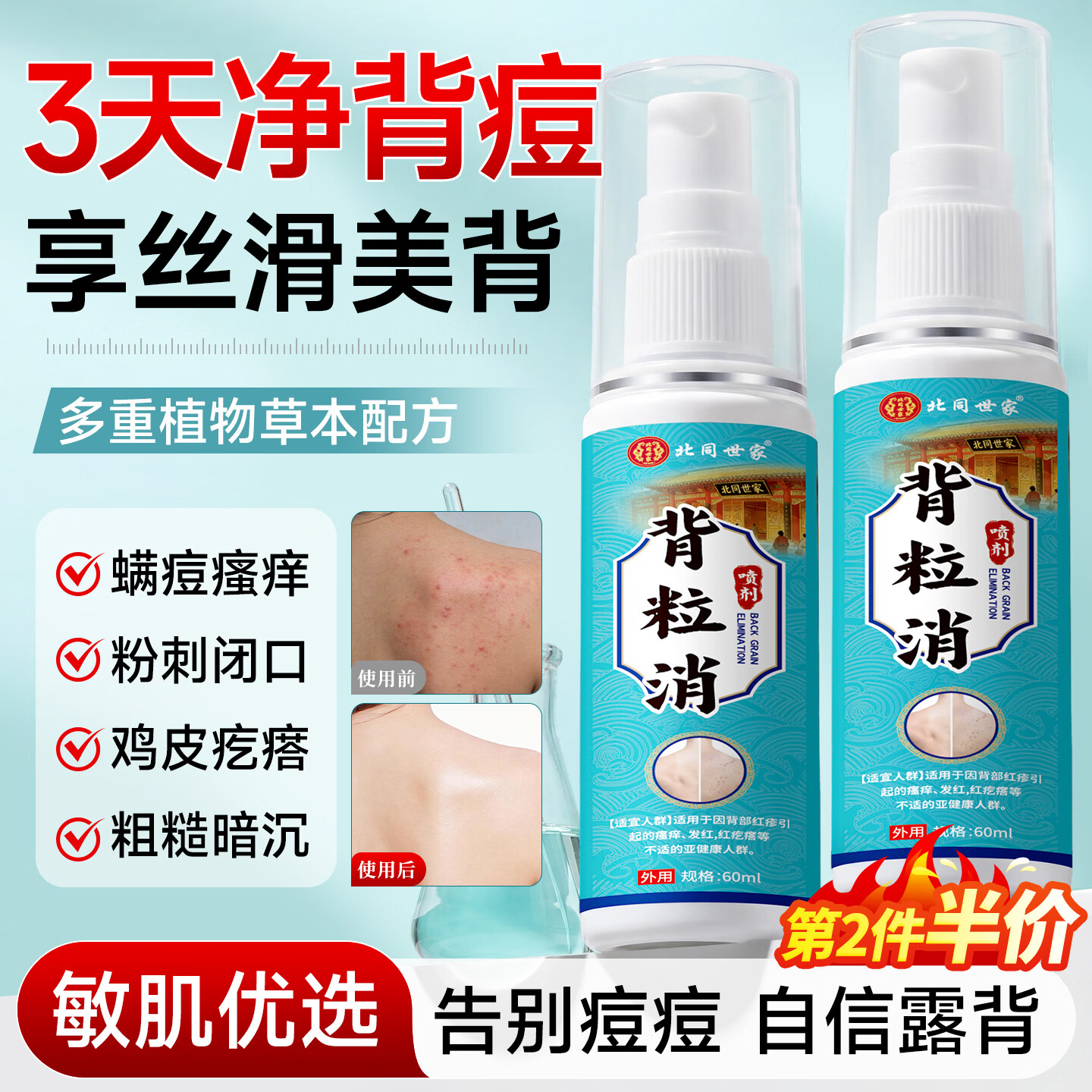 北同世家祛痘喷雾背粒消前胸后背祛痘淡化痘印粉刺背粒美背神器祛痘膏