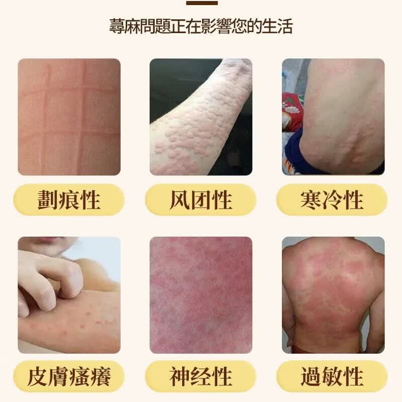 示博士【香港正品】荨麻皂草本肤康肤面部手足全身 男女通用  1盒【日常清洁】贵在运费