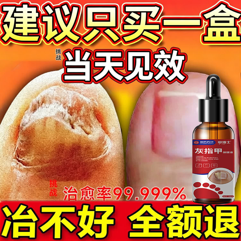 重度灰指甲100%特效专用的药特殊效专用抑菌液灰甲净套装 1盒【特效套装】1-2个灰甲选 灰指甲100%特效专用的药第一名