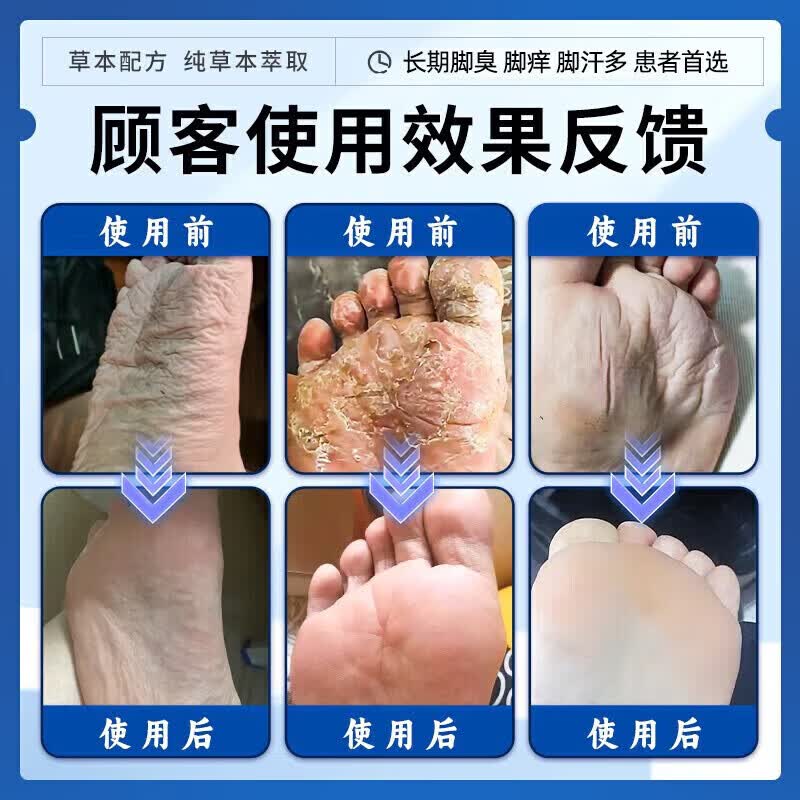 [西施兰夏露]乌洛托品溶液 40%*20ml 1盒装 汗脚止汗脚臭克星脚汗脚臭止汗喷雾除脚臭脚酸脚出汗气专用药止汗脚痒脱皮烂脚 脚底出汗