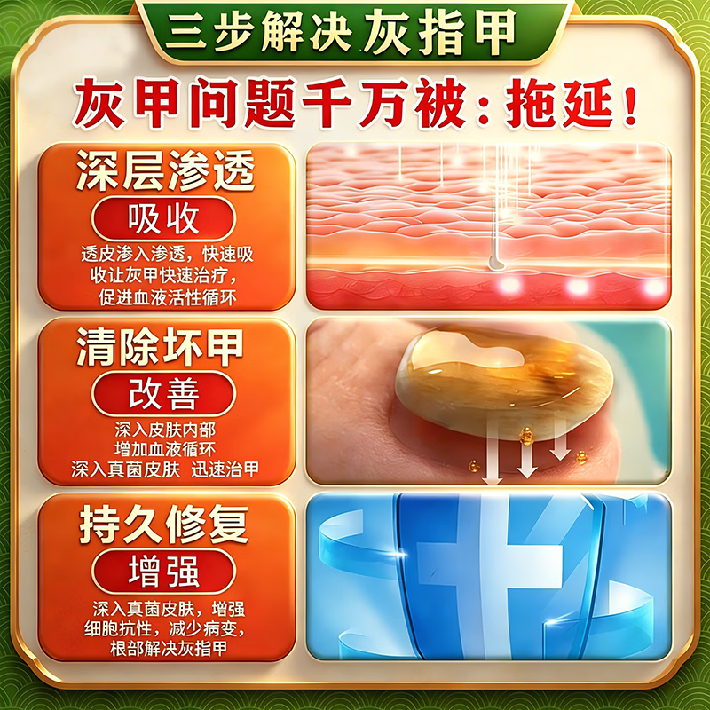 [金归]环吡酮胺乳膏 治疗灰指甲专用药最特新效药指甲增厚发黄变厚重度指甲手足真菌感染根药治皮肤用药 1%*20g 1盒装 【建议多盒治】