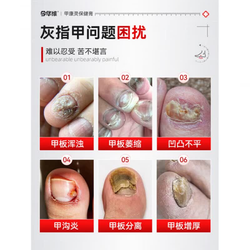YUNV甲康灵保健膏华北制药健康涂抹灰指甲草本养护空甲外用专用软膏 2支【巩固装】甲板萎缩