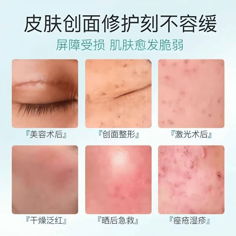 思丽安乳膏壬二酸20%祛痘凝胶去粉刺闭口淡化痘印玫瑰痤疮软霜膏 买3送2【5盒】巩固装