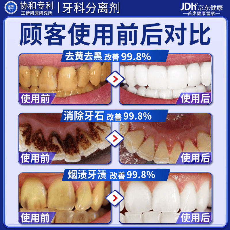 北京协和医学院牙结石专用牙膏溶解牙石去口臭去黄牙结石强力溶解液医用去除器 【永不再长牙结石】买五送四 牙结石清理神器溶解液速效漱口水