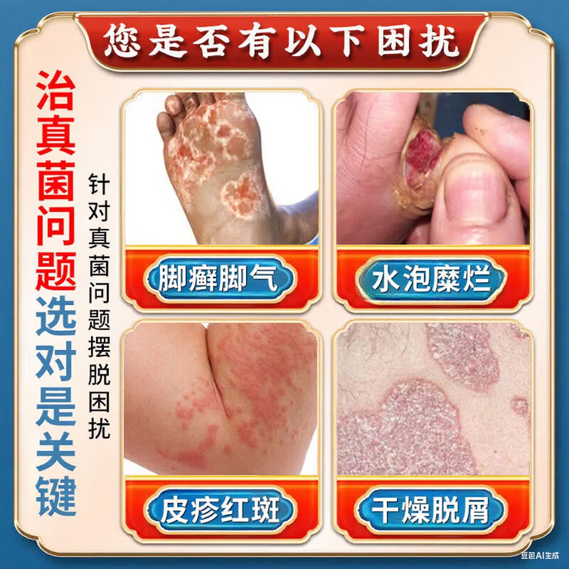 云南本草【云南真菌王】止痒膏皮肤瘙痒皮诊湿痒脚气脚臭脱皮真菌感染 1盒【云南真菌王】试用装