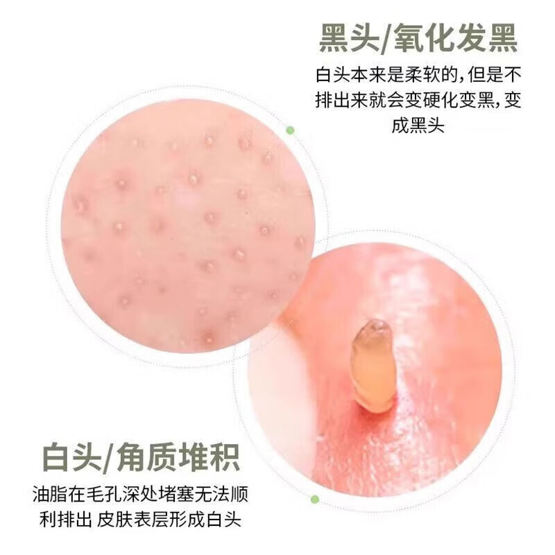 2025新款黑头手动粉刺面部清洁毛囊毛孔黑头铲刮板脸部刮脸黑头小铲子随身便携 2个装-美容刮铲【一刮即净+告别黑头】