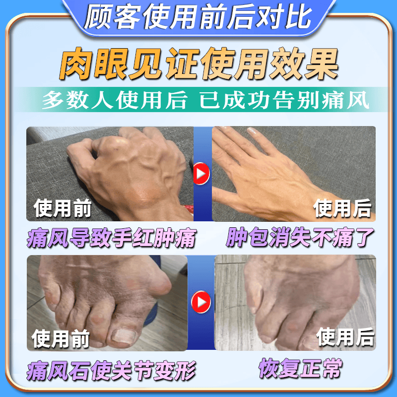 岩井昃弘痛风结晶溶解药去除痛风石膏药贴降i尿酸消肿止痛尿酸高关节疼痛 特效3盒膏【200%治根】日本进口 特效新i版专用膏强力结晶进口