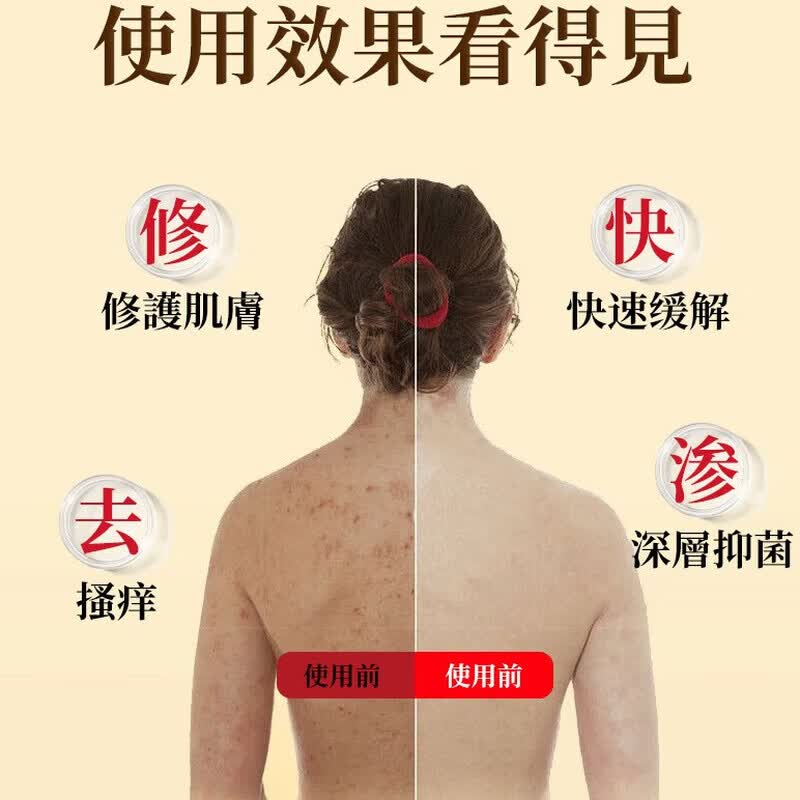 示博士【香港正品】荨麻皂草本肤康肤面部手足全身 男女通用  1盒【日常清洁】贵在运费