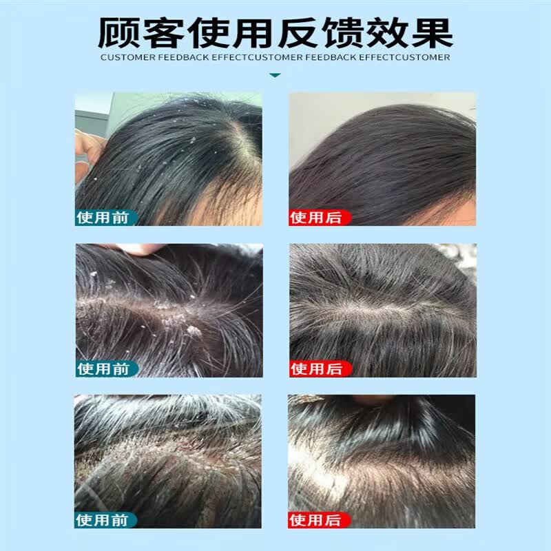 康王洗发i水去屑止痒皮炎毛囊炎脂溢性皮炎湿疹皮癣真菌感染 1盒 体验装