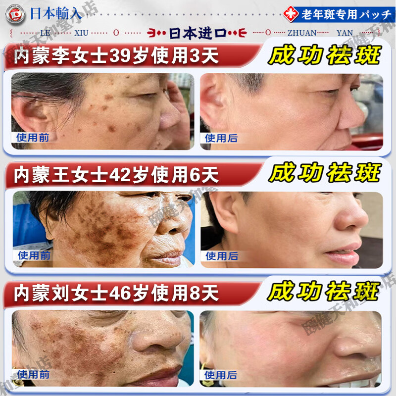 藤川岗田祛斑霜老年斑专用一夜消去黄褐雀斑晒斑女士用的脸部手背医用正品 特效:一盒装【日本进口一夜消】 白美淡化祛斑去黑色素黄褐雀斑晒斑男女士用的特效非药