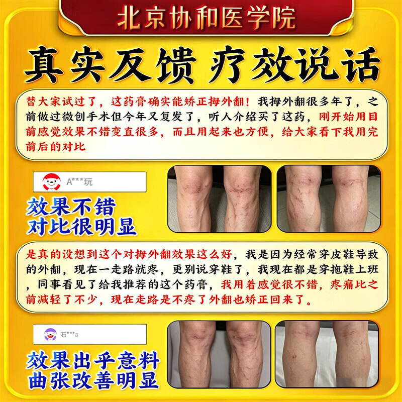 北京协和医学院静脉曲张专用膏药蚯蚓腿疏通血管堵塞进口药冷敷凝胶治疗静脉舒膏 特效1盒【专治曲张】北京协和 特效静脉曲张喷雾专用贴的