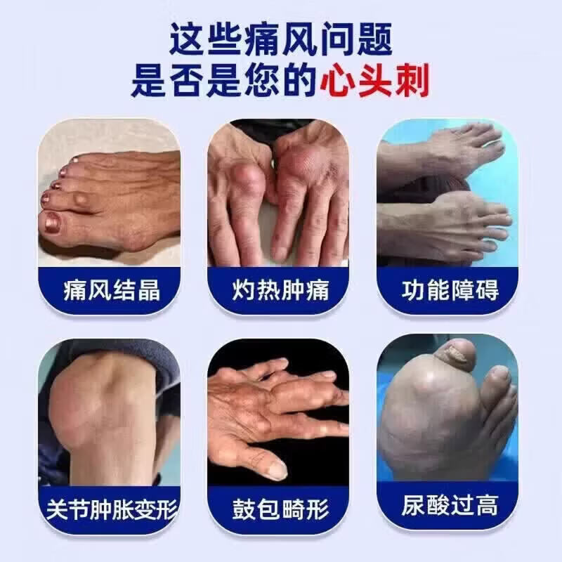仲夫子硝酸片进口痛风专研肩颈腰腿膝盖疼痛痛风性关骨不适消肿 两盒装【超值周期大部分选择】