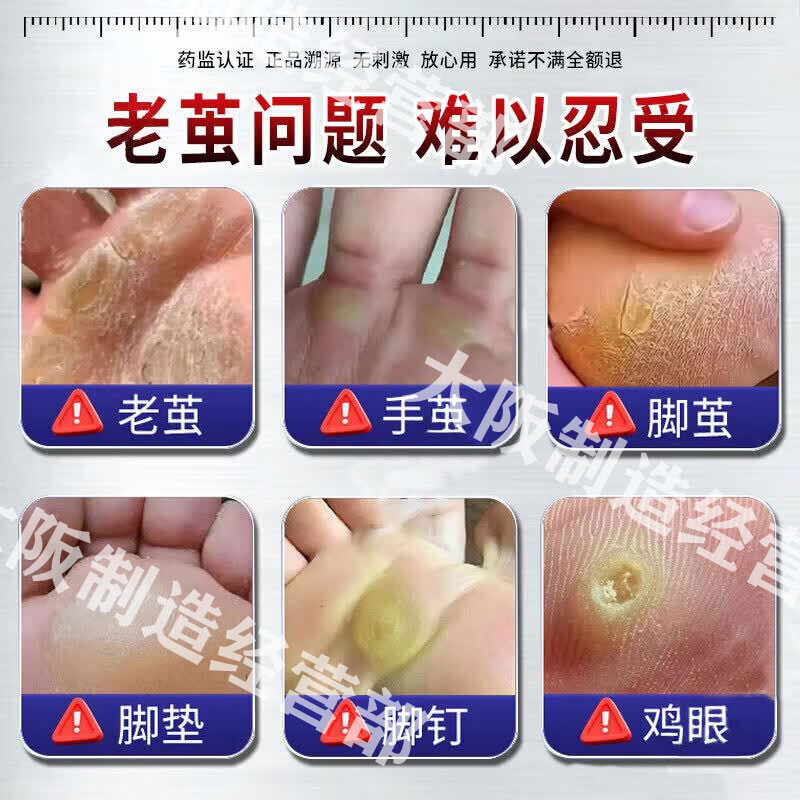 茧立净去老茧子脚茧厚茧去鸡眼脚底脚后跟硬皮去除去i根软化膏 特效买二送一【200%包脱落】 鸡眼膏老茧去除液