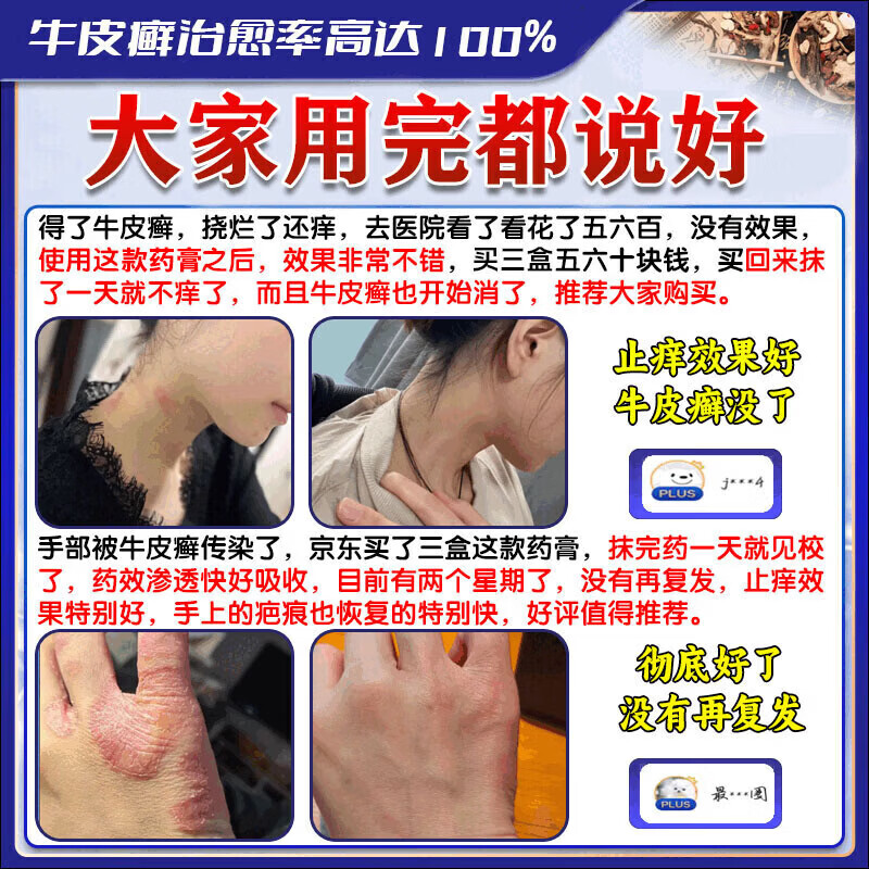 北京协和医学院牛皮癣断根药皮肤癣膏药真菌止痒抑菌皮肤顽固牛皮癣i药膏进口 特强效一盒【牛皮癣克星】 银屑病牛皮癣皮肤癣专用特强效膏