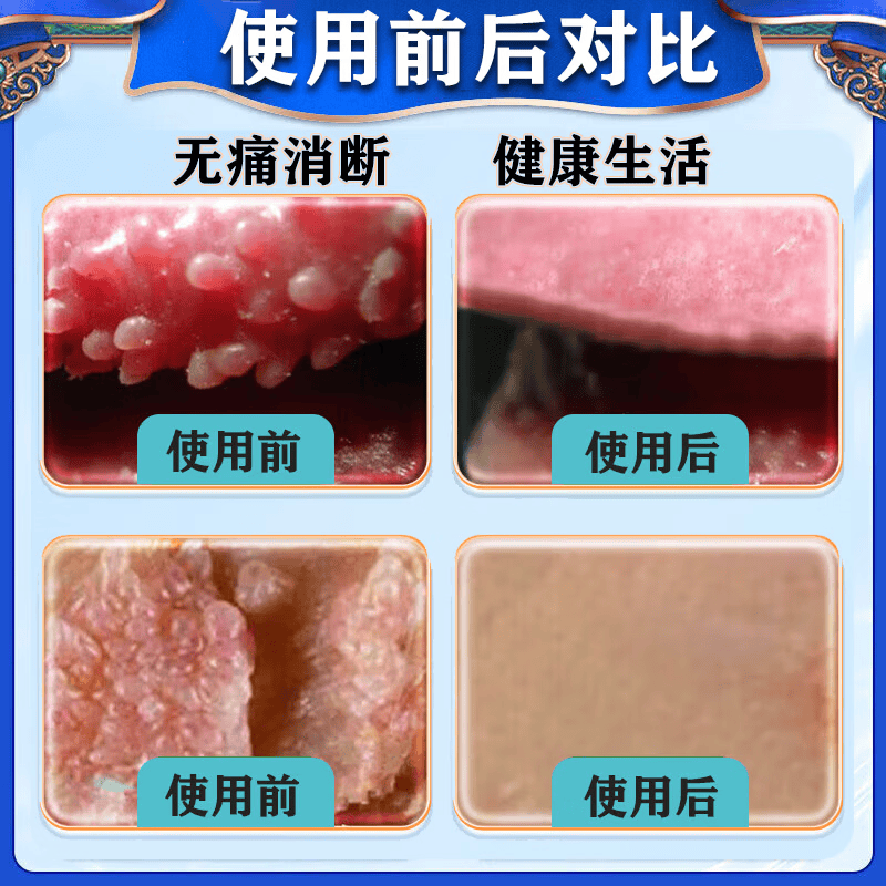 祥醫堂鬼臼毒素酊5%正品软膏尖锐湿疣私处专用脱落膏hpv去祛疣体的药女 一瓶装【鬼臼毒素酊】