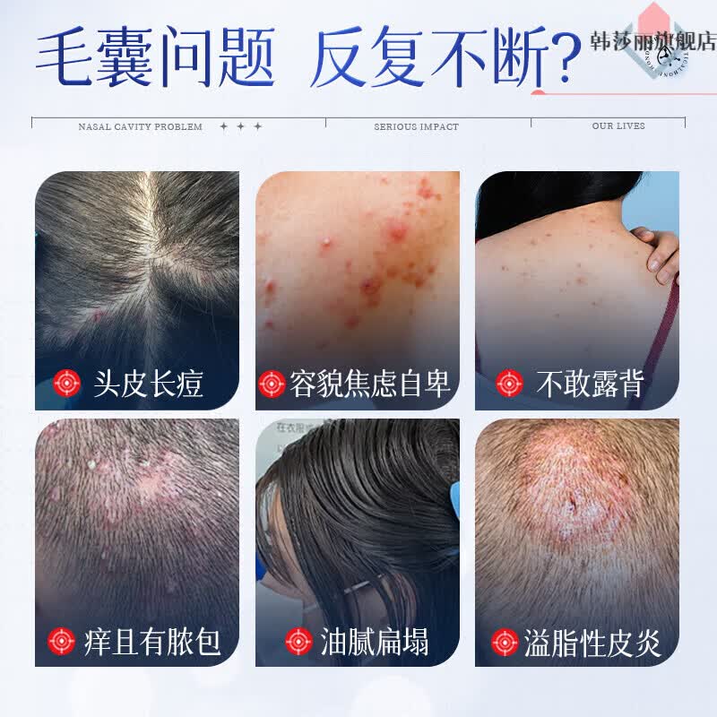 抑菌液脂溢性皮炎毛囊炎喷剂官方旗舰店皮肤痒液体敷料湿疹 一瓶装 体验装 头皮反复长痘红痒 抑菌舒缓毛囊炎症