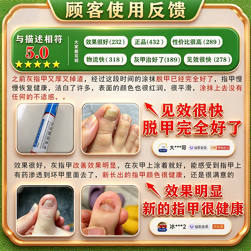 [金归]环吡酮胺乳膏 治疗灰指甲专用药最特新效药指甲增厚发黄变厚重度指甲手足真菌感染根药治皮肤用药 1%*20g 1盒装 【建议多盒治】