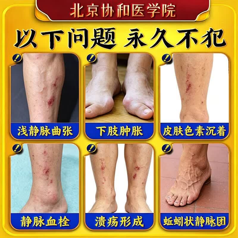 北京协和医学院静脉曲张专用膏药蚯蚓腿疏通血管堵塞进口药冷敷凝胶治疗静脉舒膏 特效1盒【专治曲张】北京协和 特效静脉曲张喷雾专用贴的