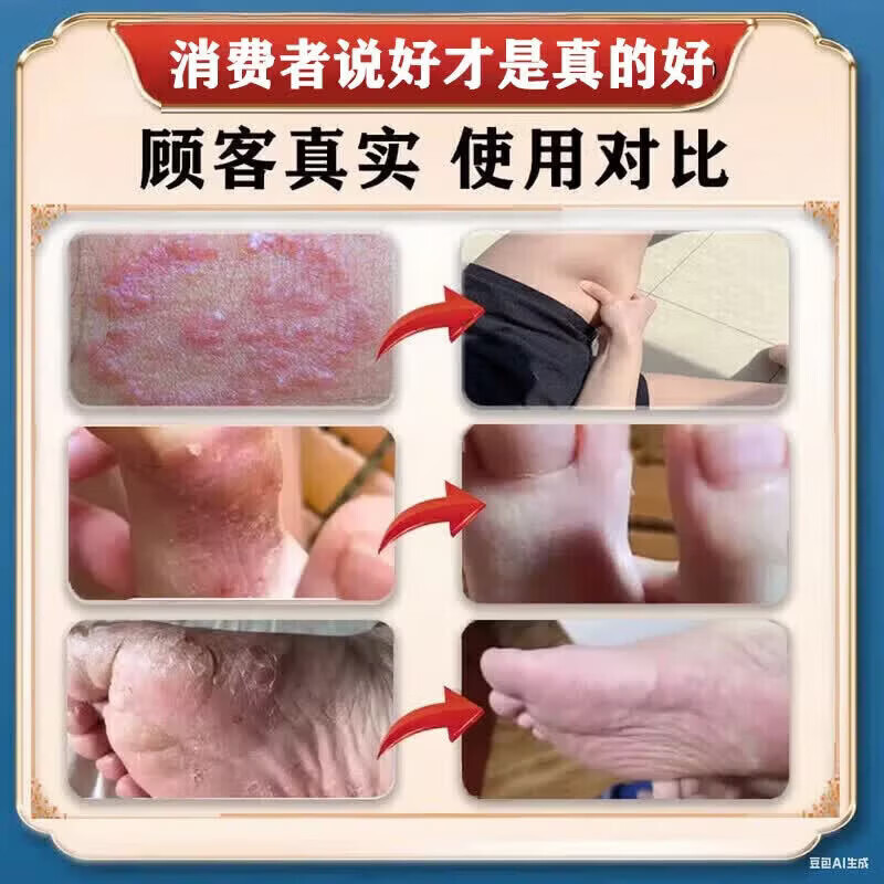 云南本草【云南真菌王】止痒膏皮肤瘙痒皮诊湿痒脚气脚臭脱皮真菌感染 1盒【云南真菌王】试用装