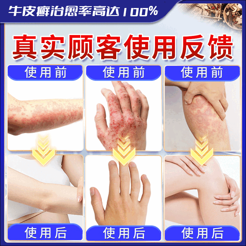 北京协和医学院牛皮癣断根药皮肤癣膏药真菌止痒抑菌皮肤顽固牛皮癣i药膏进口 特强效一盒【牛皮癣克星】 银屑病牛皮癣皮肤癣专用特强效膏