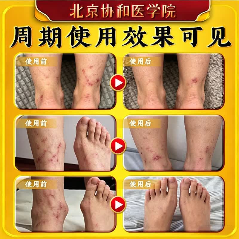 北京协和医学院静脉曲张专用膏药蚯蚓腿疏通血管堵塞进口药冷敷凝胶治疗静脉舒膏 特效1盒【专治曲张】北京协和 特效静脉曲张喷雾专用贴的