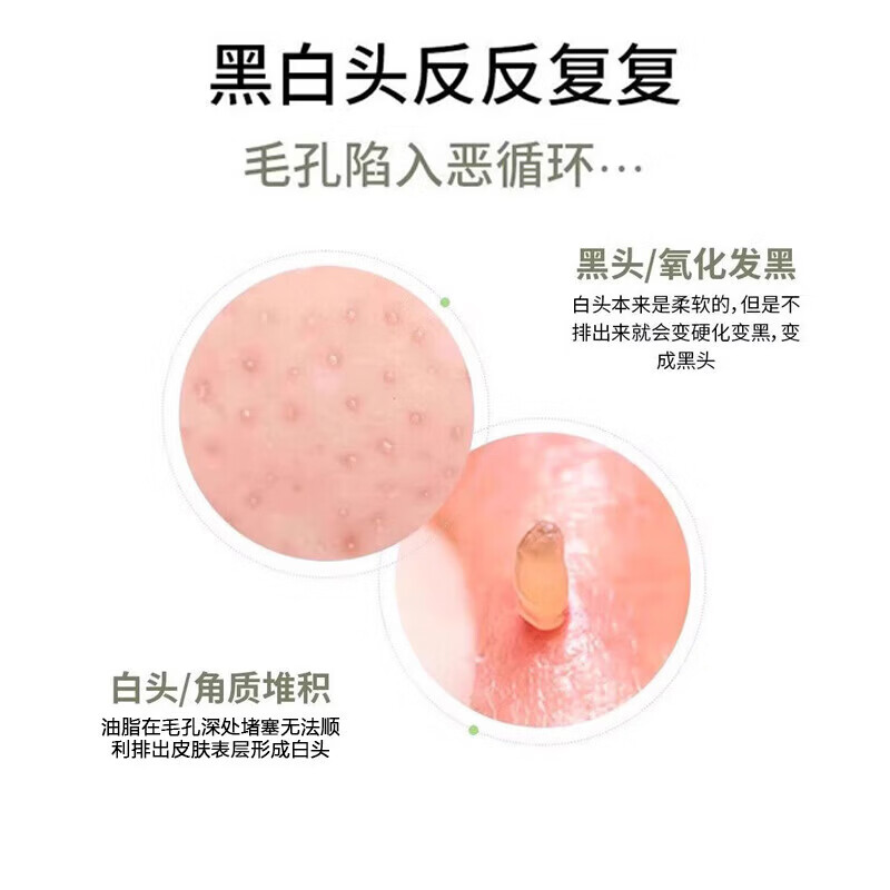 2025新款黑头手动粉刺面部清洁毛囊毛孔黑头铲刮板脸部刮脸黑头小铲子随身便携 2个装-美容刮铲【一刮即净+告别黑头】