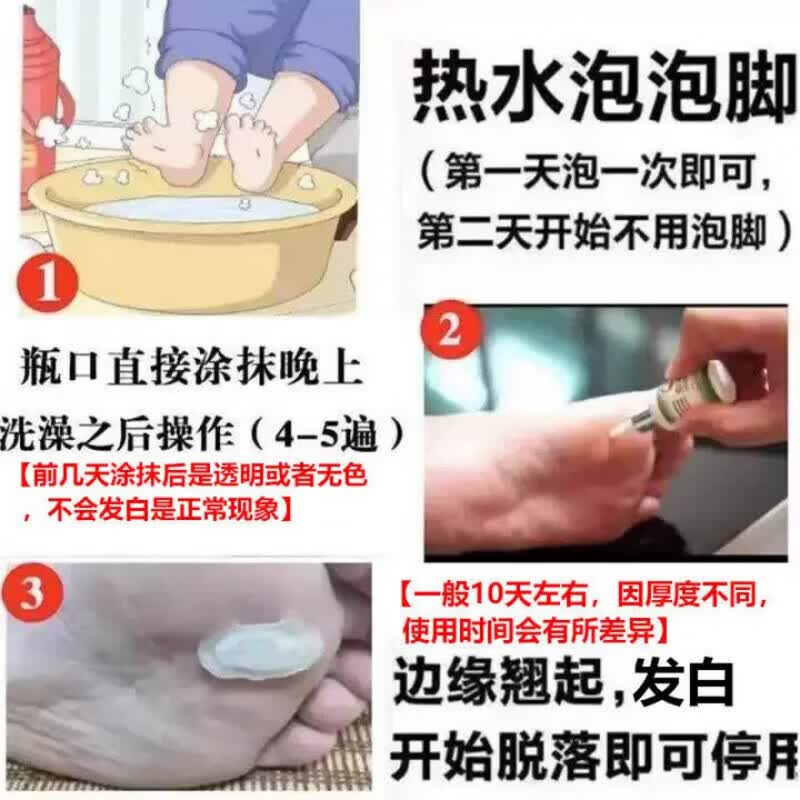 黄辅堂茧立净老茧子脚茧厚眼鸡草本萃取手足脚底板用正品 买五送五  到手10瓶 正品保障