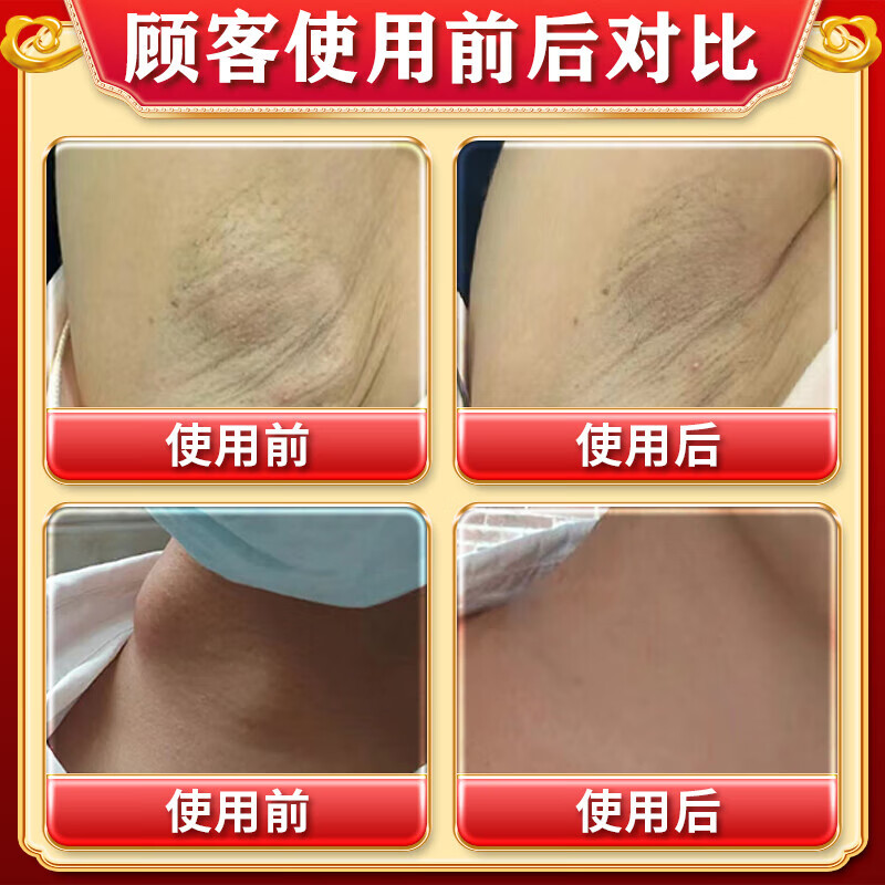 淋巴结散结膏淋巴结膏专用颈部肿大发炎消炎药脖子颈部散结膏 一盒装