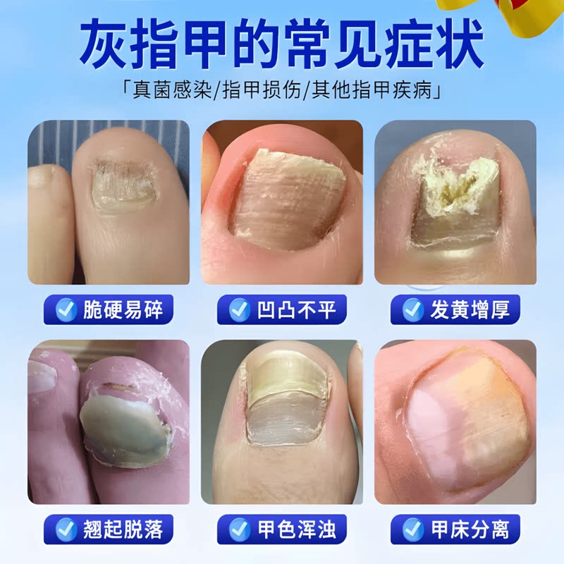 德国灰指甲笔德国进口指甲笔喷雾水指甲笔外用原装进口0td 1支【德国进口】 品牌直售