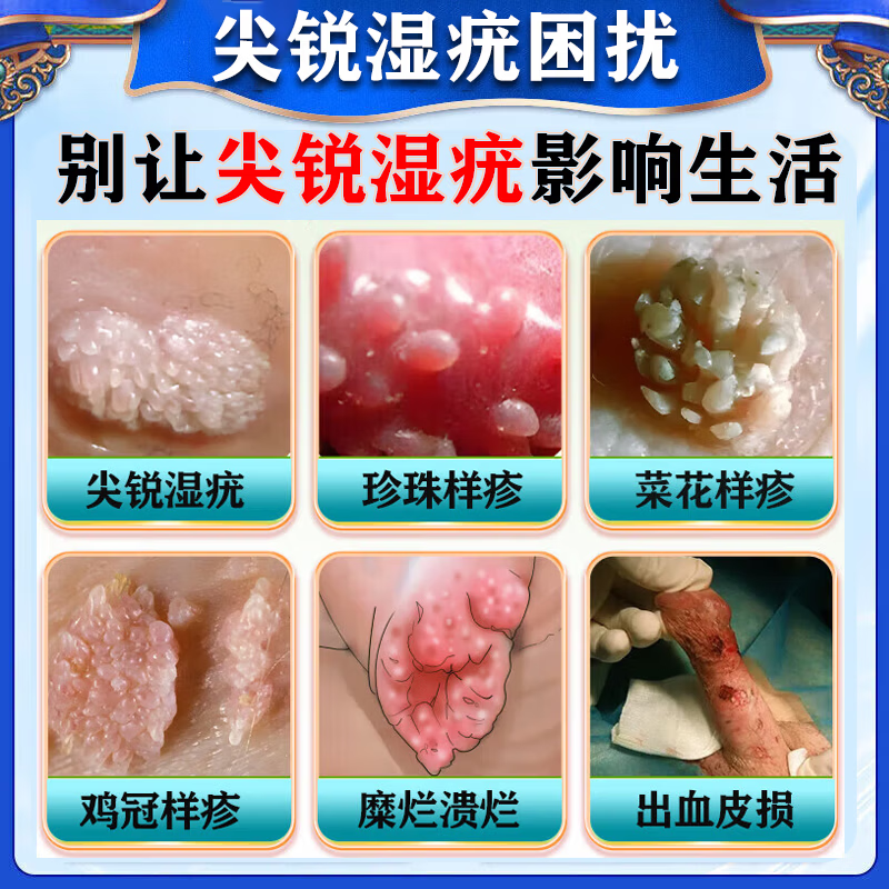 祥醫堂鬼臼毒素酊5%正品软膏尖锐湿疣私处专用脱落膏hpv去祛疣体的药女 一瓶装【鬼臼毒素酊】