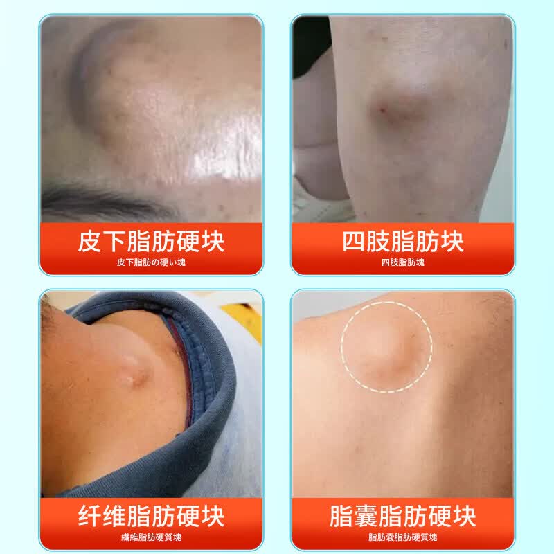 宁仲医脂肪康消膏贴皮下肿硬块专用去除皮脂腺囊肿蓖麻子非神器特效膏 体验装【1盒】20g/支 官方直销 京质保障