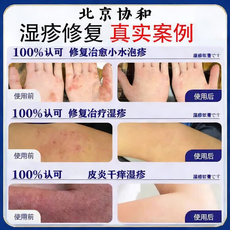 岩井昃弘湿疹膏十大牌子进口湿疹膏止痒抑菌皮肤瘙痒去顽固湿毒真菌感染 特效5盒【此生不再范】日本进口湿疹膏药特效止痒去根 湿疹十大牌子皮肤瘙痒皮炎湿疹