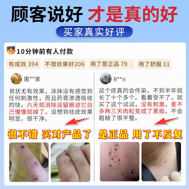 祥醫堂祛疣膏脖子上小肉粒扁平i疣丝状i疣面部药专用脖子克优膏脖子肉粒 升级款软膏【1盒】