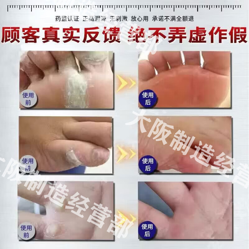 茧立净去老茧子脚茧厚茧去鸡眼脚底脚后跟硬皮去除去i根软化膏 特效买二送一【200%包脱落】 鸡眼膏老茧去除液
