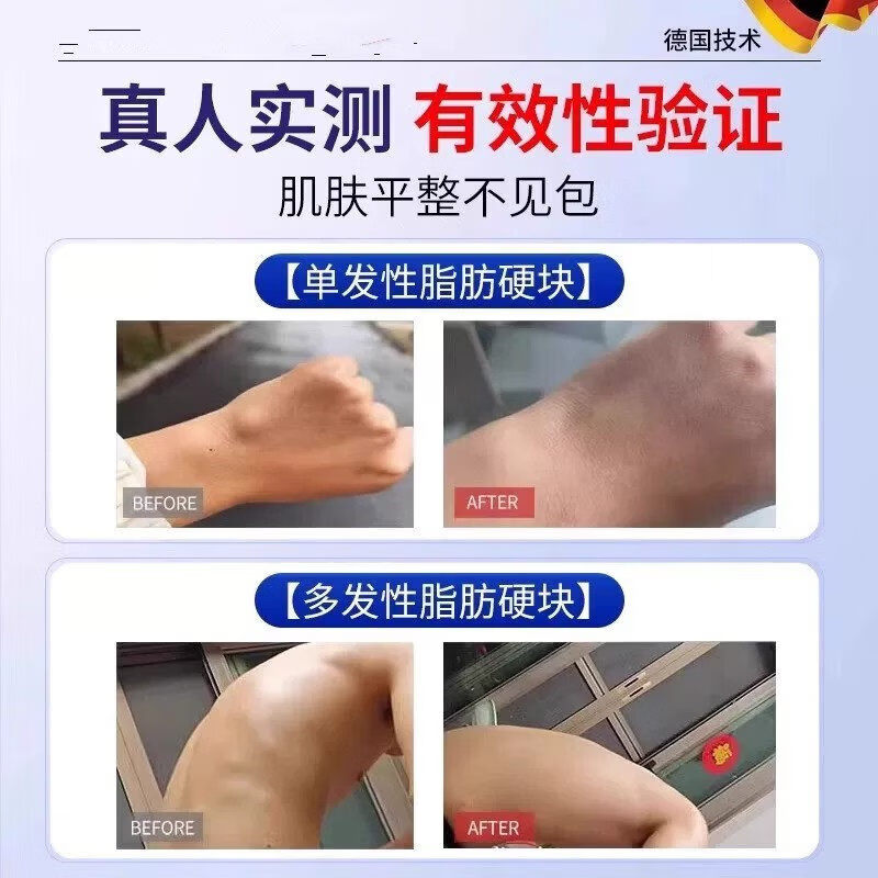 宁仲医脂肪康消膏贴皮下肿硬块专用去除皮脂腺囊肿蓖麻子非神器特效膏 体验装【1盒】20g/支 官方直销 京质保障