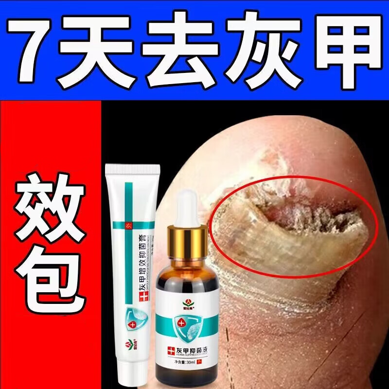 常民膏去灰指甲修护液发黑分离去除增厚灰甲亮l甲脱甲膏喷剂专用修护