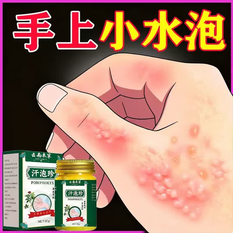 云南汗泡疹本草膏疱珍抑菌汗孢疹手上起小汗泡汗泡珍瘙痒抑菌膏 1盒*50g[初步效果】