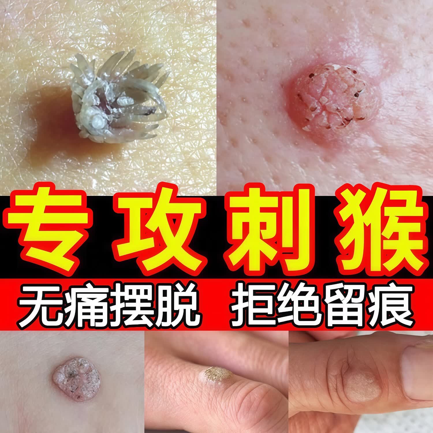 七黎【一洗就掉】祛疣皂瘊尤皂猴子小肉粒痘痘粉刺清洁去尤香皂全身 2盒装半价【肌肤滑嫩】53%客户选择 京东折扣/优惠券