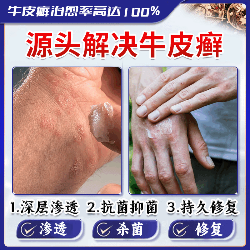 北京协和医学院牛皮癣断根药皮肤癣膏药真菌止痒抑菌皮肤顽固牛皮癣i药膏进口 特强效一盒【牛皮癣克星】 银屑病牛皮癣皮肤癣专用特强效膏