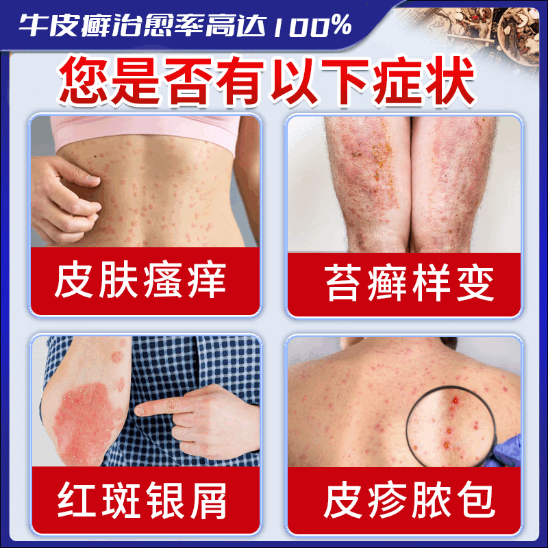 北京协和医学院牛皮癣断根药皮肤癣膏药真菌止痒抑菌皮肤顽固牛皮癣i药膏进口 特强效一盒【牛皮癣克星】 银屑病牛皮癣皮肤癣专用特强效膏