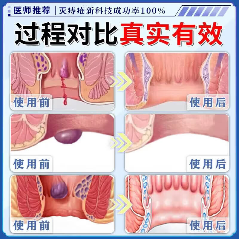 德国原装进口痔疮i膏痔疮凝胶专用去肉球根断专用特强效药痔治根 100%特效:1盒[德国进口】 消痣苍膏痔根断正品痔疮凝胶去肉球内外混合痔疮药专用